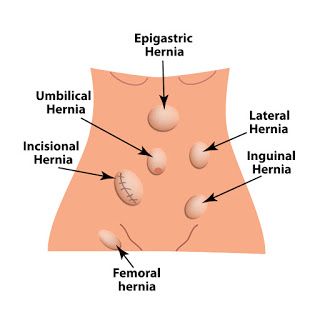 Research And Future Directions In Laparoscopic Hernia Repair