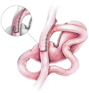 Key Steps In The Laparoscopic Mini Gastric Bypass Surgery