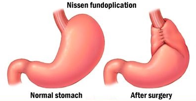 Laparoscopic Fundoplication