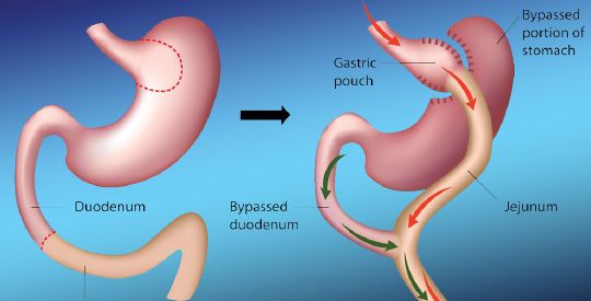 Integrating Robotics Technology In Laparoscopic Roux-en-Y Gastric Bypass Surgery