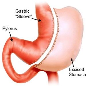 Laparoscopic Sleeve Gastrectomy In Adolescents