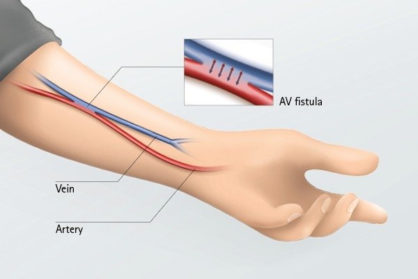 Advances In Fistula Surgery: Emerging Techniques And Technologies