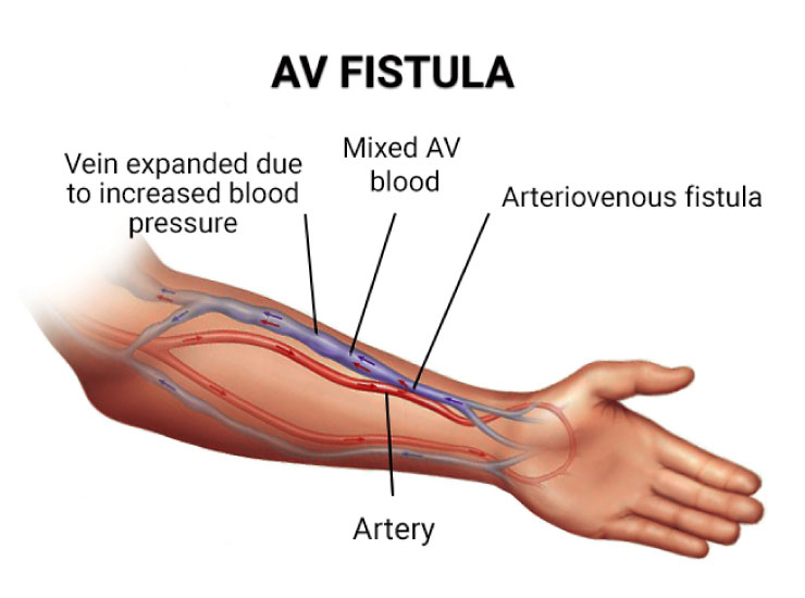 Robotic-Assisted Fistula Surgery: Precision And Advancements In Technology