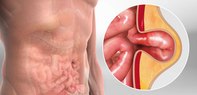 Hernia Surgery: Understanding the Procedure Recovery and Outlook.