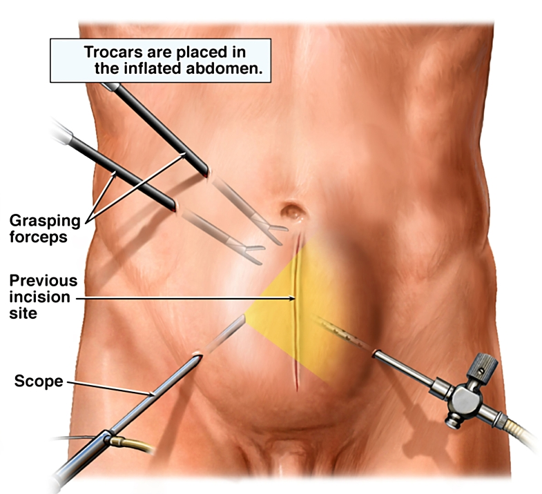 Best Hernia Surgery Hospital in Dwarka