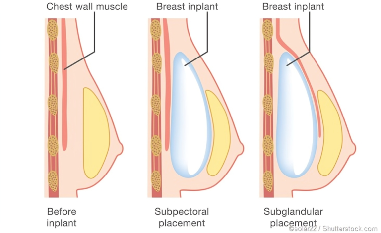 Reclaim Your Body: Transformative Results of Breast Surgery.