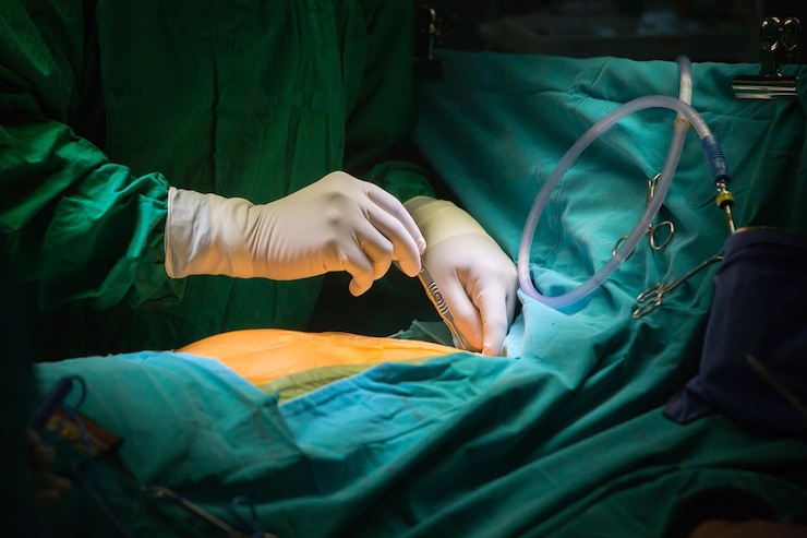 The Shocking Truth About Fistula Surgery: Are You Prepared?