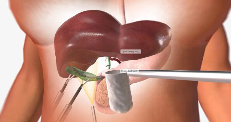 Innovative Solutions: Laparoscopic Techniques in Gastrointestinal Medicine.