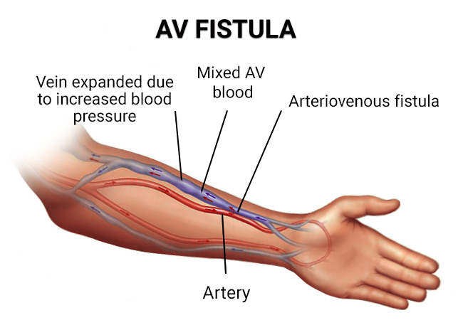 Expert Fistula Surgery in Patel Nagar