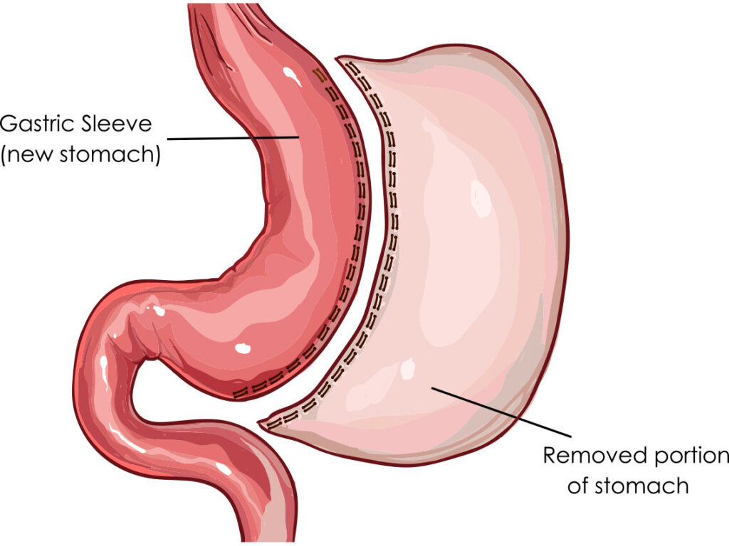 Best Laparoscopic Sleeve Gastrectomy Surgery in Patel Nagar