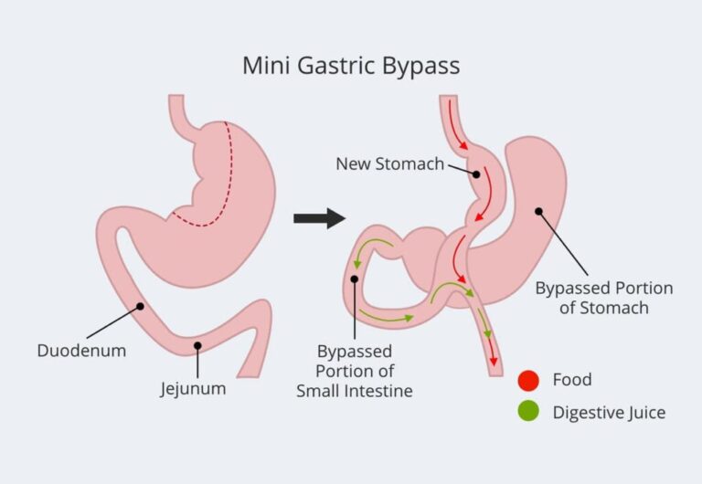 Best Laparoscopic Mini Gastric Bypass Surgery in Patel Nagar