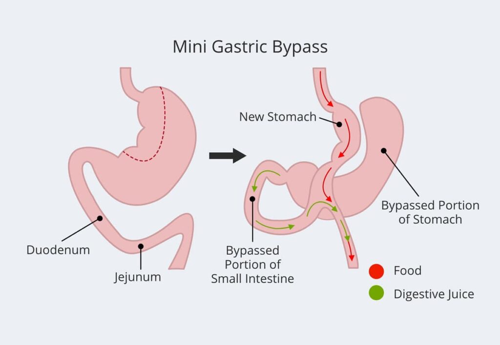 Best Laparoscopic Mini Gastric Bypass Surgery in Patel Nagar