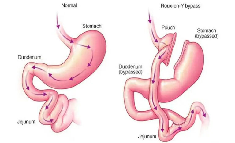 Best Laparoscopic RouxenY Gastric Bypass Surgery in Patel Nagar