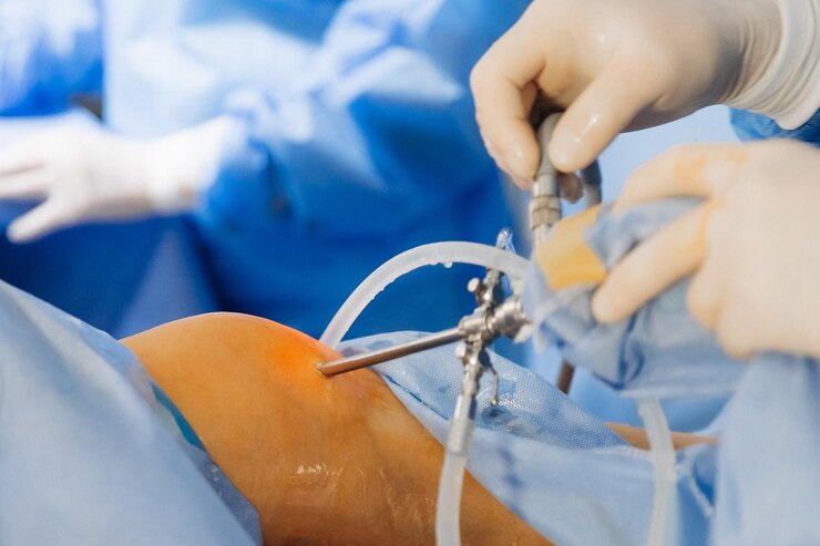 Expert Hernia Surgery in Patel Nagar