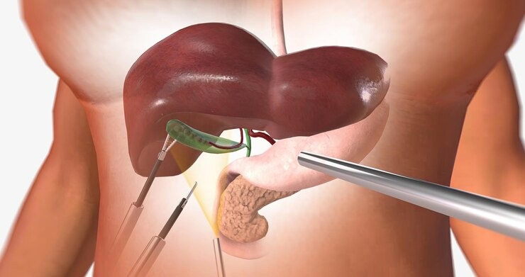 Best Gallbladder Laparoscopic Surgeon in North Delhi