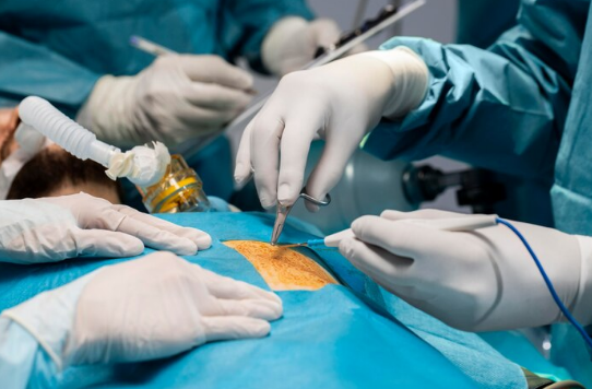 Best Hemorrhoid Surgery in North Delhi