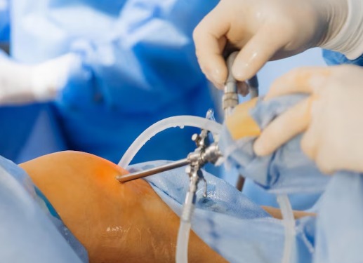 Best Hernia Surgery in North Delhi