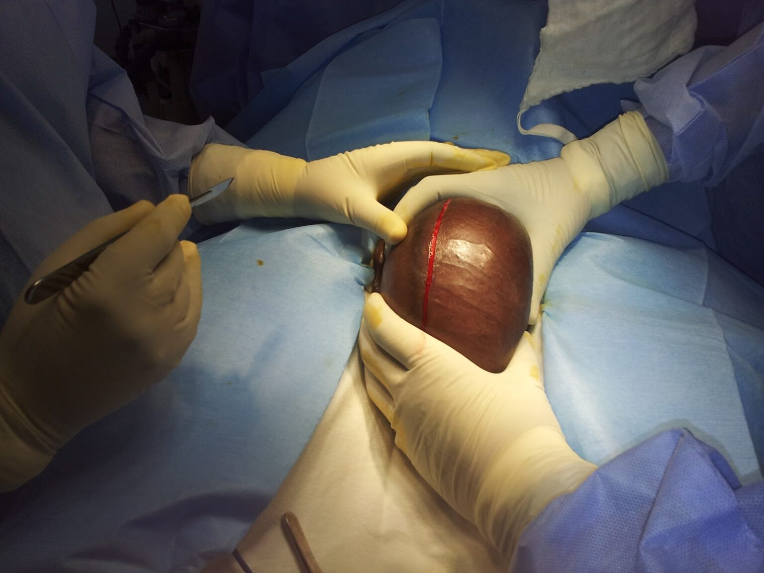 Best Hydrocele Surgery in North Delhi