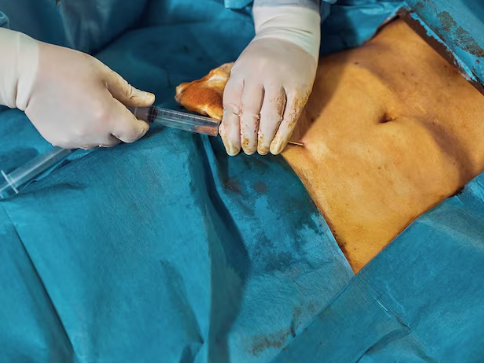 Best Circumcision Surgeon in North Delhi