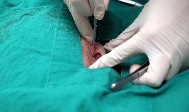 Best Pilonidal Sinus Surgery in Delhi